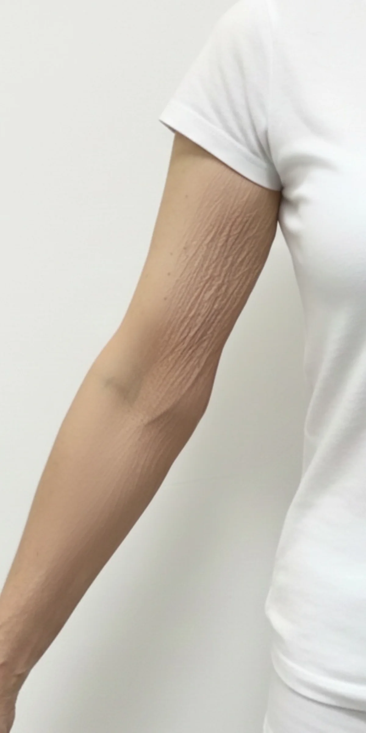 Crepey upper arm before Advanced Crepe Fix