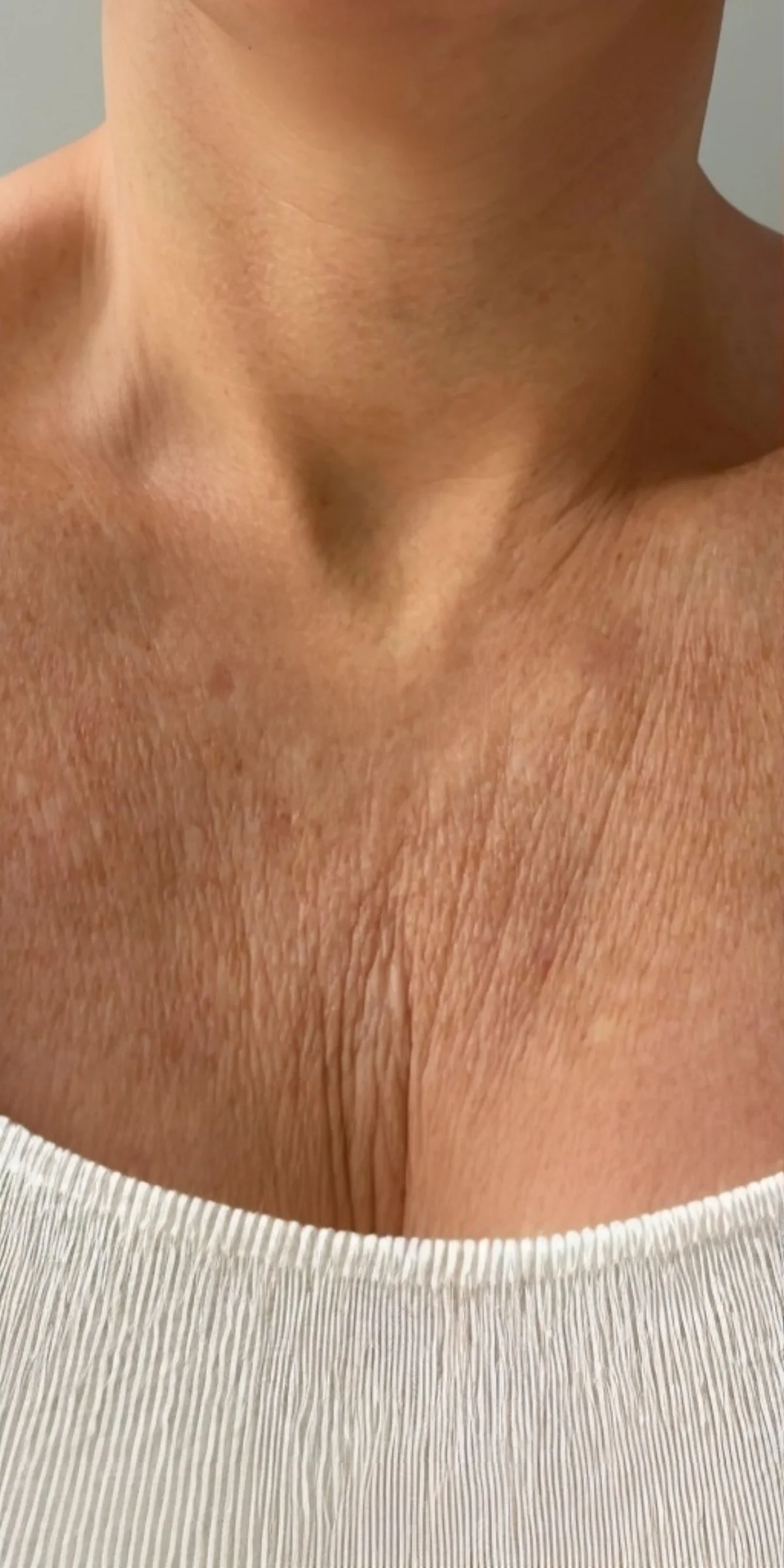 Crepey chest before Advanced Crepe Fix