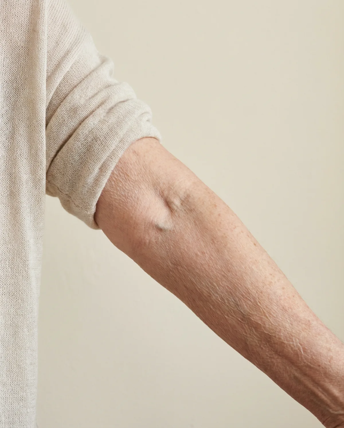 Crepey forearm before Advanced Crepe Fix